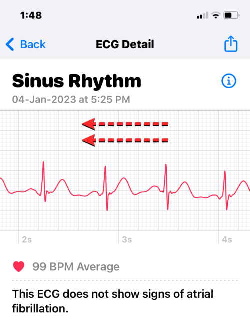 Apple Watch 心电图记录:详细步骤指南