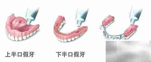 活动义齿优缺点及护理方法